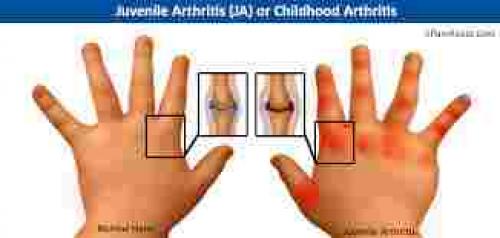 علاج التهاب مفاصل الاصابع