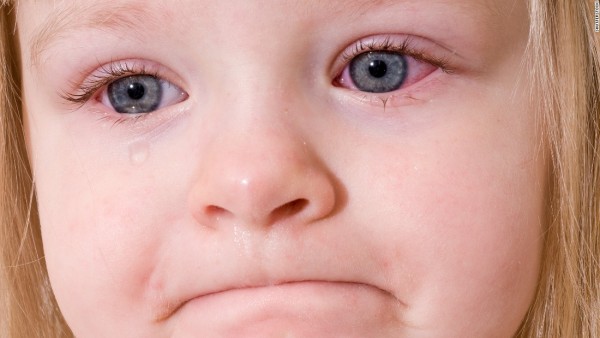 علاج التهاب العين عند الاطفال بالكمادات