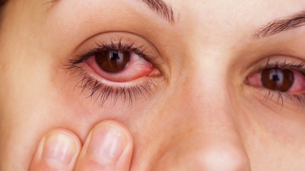 وصفات مجربة لعلاج التهاب العين عند الأطفال والكبار