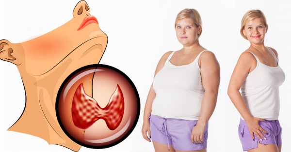 طرق خسارة الوزن لمرضى الغدة الدرقية ضعف الحرق