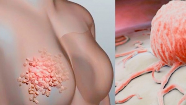 ما هي علامات التحذير من سرطان الثدي ؟